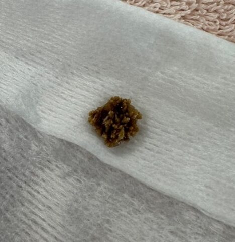 a bladder stone removed from a dog